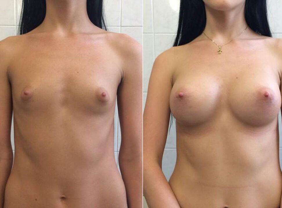 Foto prima e dopo l'uso della crema Wow Bust di Anna da Berlino